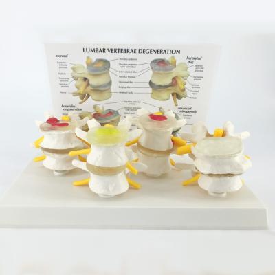 China High quality four stage normal teaching model and lumbar vertebra pathological model for demonstration for sale