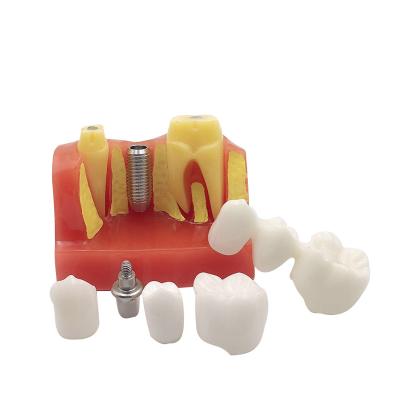 China Durable Basic Dental Implant Demonstration Model Dental Implant Training Teaching Model for sale