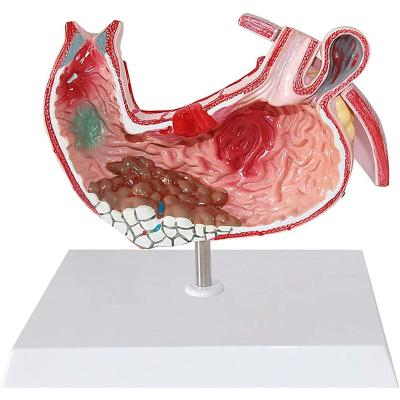 China Durable Stomach Model Human Gastric Lesion Anatomy Model Anatomy Pathological Model for sale