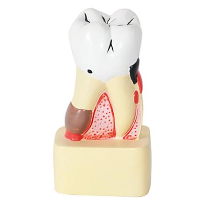 China Anatomical Teaching Models Human Dental Model Oral Care Health Care Dental Caries Model for sale