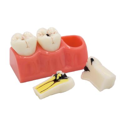 China Durable Anatomical Tooth Model Caries Dental Model 4X Model for sale