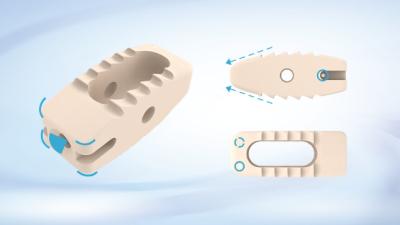 China Spinal Alignment Lumbal Interbody Fusion Käfig Lumbal Spinalkäfig zu verkaufen