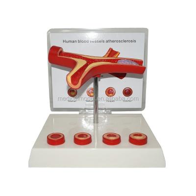 China Realistic Human Simulation Atherosclerosis and Thrombosis Blood Vessel Pathology Model for sale