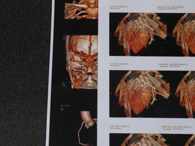 Chine 240gsm 180 Micron Medical Inkjet Film 3D CT Chest Film Environmental Friendly à vendre