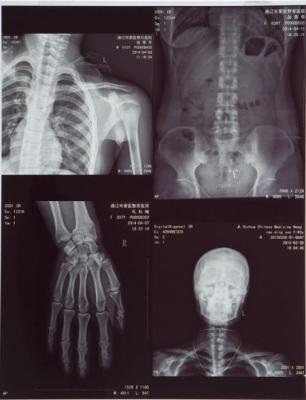 China 11X14 Inch Medical X-ray Film/Analogue Medical Film/Dry Film for sale