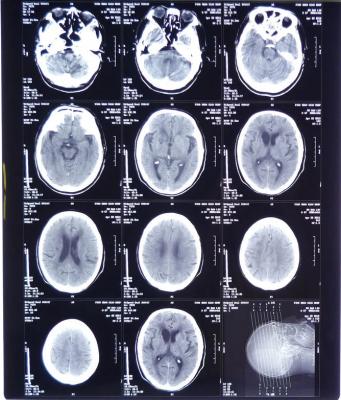 China Película médica de rayos X de alta claridad FUJI DIHT 14*17in Película de imagen seca con láser en venta