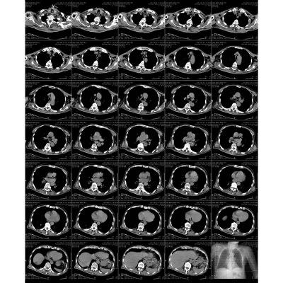 China Erweiterte Blaue Laser-Druckbare Radiografische Laserfilm mit thermischem Druckverfahren zu verkaufen