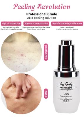 China Exfoliating Serum Huid Peeling Solution Acne Remover Huidverzorging Huid Peeling 30 ml Te koop