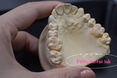 Cina Effettiva E.Max / Infissi e infissi compositi per la riparazione di denti danneggiati o decaduti in vendita