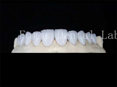 China Gepersonaliseerde natuurlijke porseleinen veneers tandheelkundige lab veneers vlekbestendig Te koop