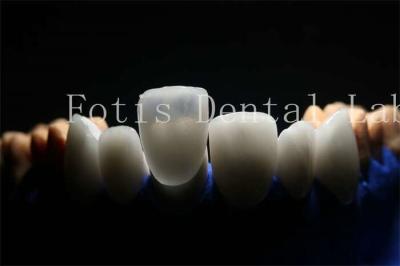 China Long-Lasting and Durable Prosthetic Laminate Veneers with Porcelain Material for sale