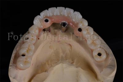 China Tasa de éxito Implantes dentales todos en 4 Procedimiento del mismo día Restauración completa de la masticación asequible en venta