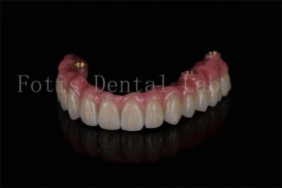 Cina Ripristino dell' arco completo tutti su quattro impianti per prestazioni ottimali degli impianti dentali in vendita