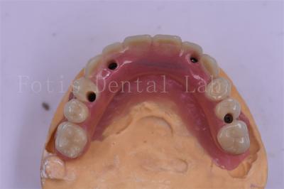 Cina Impianto dentale in titanio corona dentale di precisione adatta Disegno personalizzato in vendita