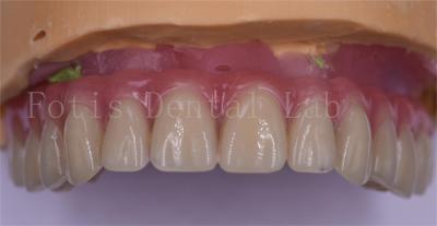 Cina Comfort del paziente Coroane dentali personalizzate in titanio/zirconia/PFM in vendita