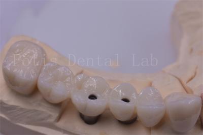 Cina Corona dentale in titanio / zirconia argento lucidato per denti mancanti in vendita