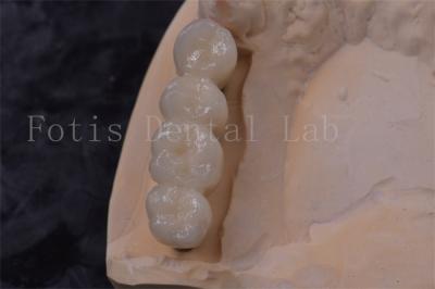 Cina Precision Fit Implantazione corona dentale di zirconia corona PFM facile da pulire in vendita