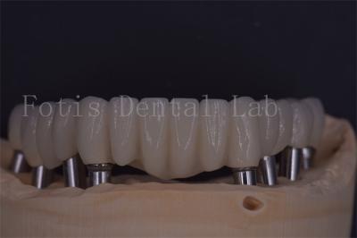 중국 편리함과 기능성 을 위한 신뢰성 있는 치아 임플란트 왕관 판매용