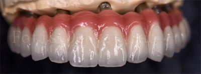 Cina Corone di laboratorio dentali resistenti alle macchie per varie sostituzioni dentali in vendita