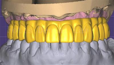 Chine Conception de couronne en 3 formes professionnelle Excellente performance et durabilité à vendre