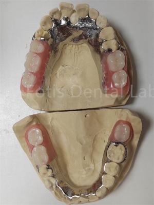 China Personalização Dentes parciais temporárias compatíveis com dentes naturais à venda