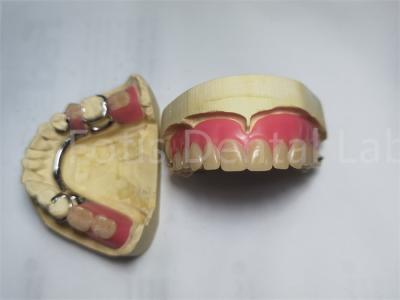 China Prótese dentária parcial / prótese dentária removível personalizada à venda