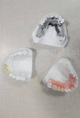 China Dentadura parcial removível flexível e duradoura Facil limpeza Substitua dentes perdidos à venda