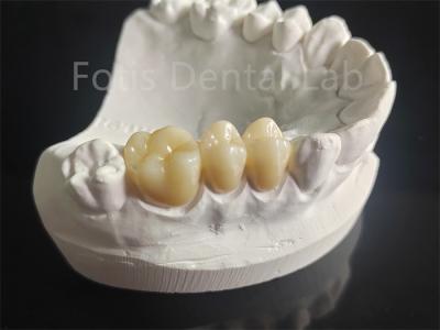 Chine Résistant à l'usure Zirconia recouverte de matériaux dentaires en porcelaine à vendre