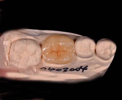 Cina Infissi indiretti e di porcellana e infissi con sovrapposizioni dentali in vendita