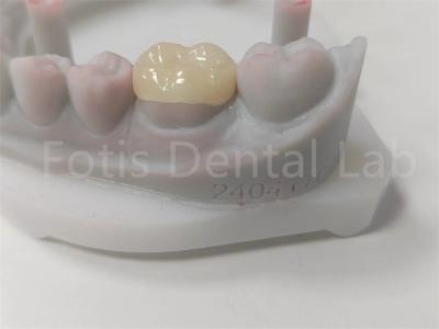 Chine OEM Dental Inlay et Onlay Restauration en céramique et remplissage dentaire coloré à vendre