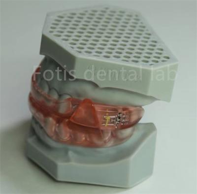 Cina Affordable Dental Lab Hyrax Expander Orthodontic Retainer Easy To Clean And Maintain in vendita