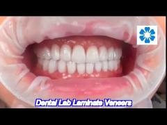 high translucency dental lab laminate veneers for natural and polishing