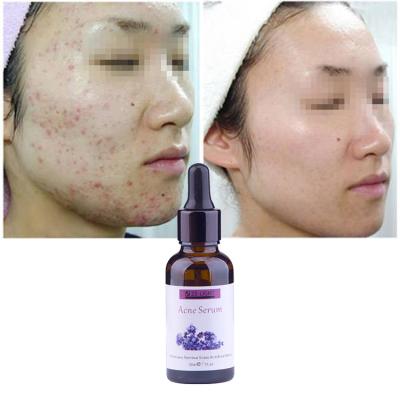 China Acne Treatment OEM Collagen Serum Private Label Acne Marks Treatment Hamamelis Blister Marks Facial Serum For Skin Face Serum for sale