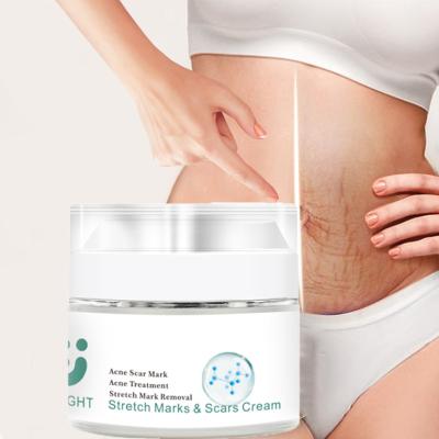 China Scar Mark High Effect Maternity Stretch Marks Removal Cream Remove Pregnancy Skin Care Scar Stretch Mark Cream for sale