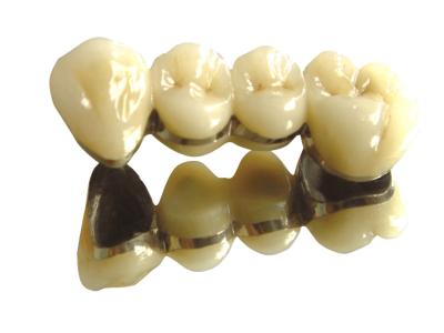 Cina Colore dei denti Cobalto Cromo Corona PFM Dental PFM di alta nobiltà in vendita