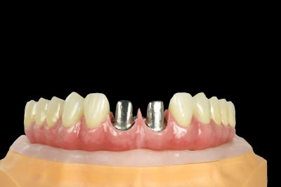 China FDA Titanium Bridge Dental Implant Titanium Framework With Crown for sale