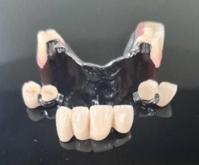 China Metal Framework Precision Attachment Overdenture Removable Tooth Denture for sale