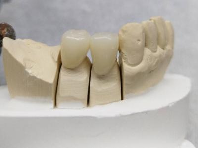 China Customized Dental Temporary Crown PMMA Temporary Bridge And Crown for sale