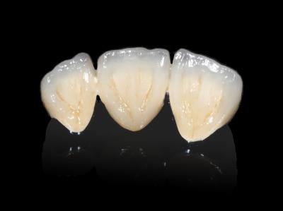 China Implant Dental PFM Bridge Non Precious CAD CAM PFM Crown for sale