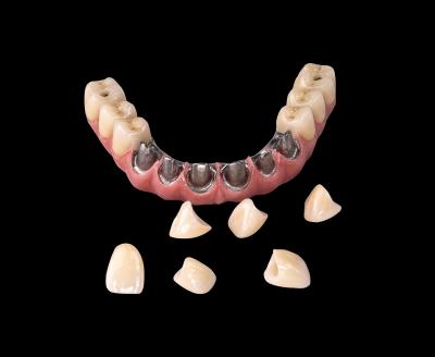 China ALL On  X Implant Titanium Bridge Dental Only Framework Professional for sale