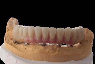 China Customize Hybrid Dental Implants Hybrid Denture With Titanium Bar for sale