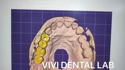 China Full Contour tandheelkundige kroon ontwerp Zirconia CE FDA gecertificeerd Te koop