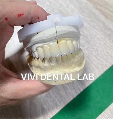 China Wafer Finos Dentários Emax Laminado Veneers Porcelana Translúcida à venda