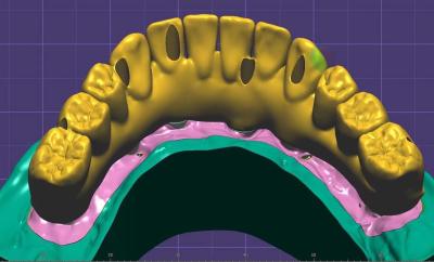 Cina Impianti e ponti di croce dentale professionale 3 Forma Exocad in vendita