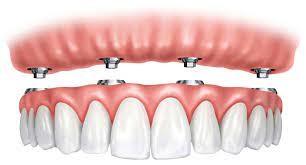 China Todo en cuatro implantes Ivoclar apoyados en dentaduras retentivas de aspecto natural en venta