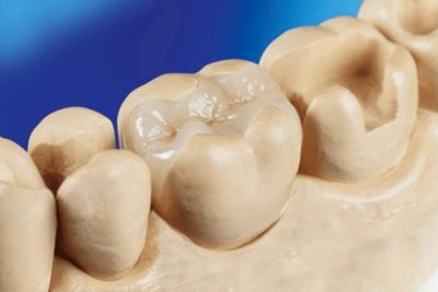 Cina Intaglio dentale in porcellana Onlay Zirconia Emax Alta estetica FDA approvato in vendita