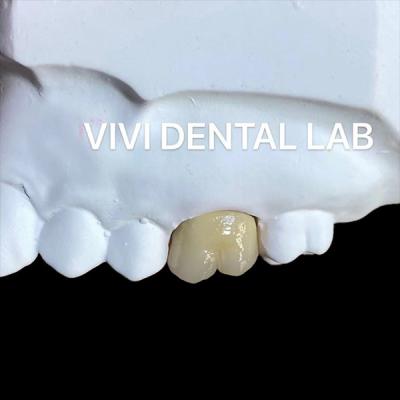 China Coroas de porcelana de metal Be Ni Precise Estética PFM Coroa Dental à venda