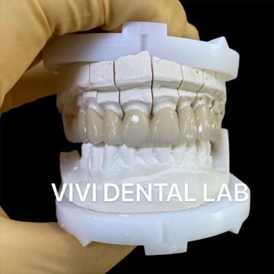 China Coronas de laboratorio dentales de precisión Estética de porcelana de zirconia Corona dental en venta