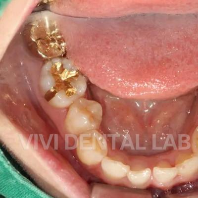 China Gold Inlay Onlay Dental Crown High Noble Yellow Ni Be Free for sale