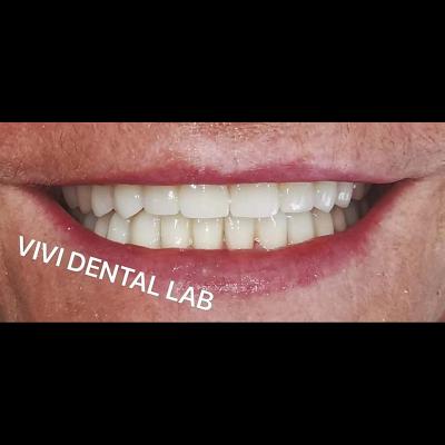 China Puente dental ISO de boca llena Puente de dientes de zircónia de múltiples capas en venta